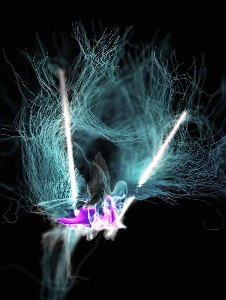 La estimulación cerebral en el hipotálamo lateral ayuda a recuperar el movimiento a dos lesionados medulares