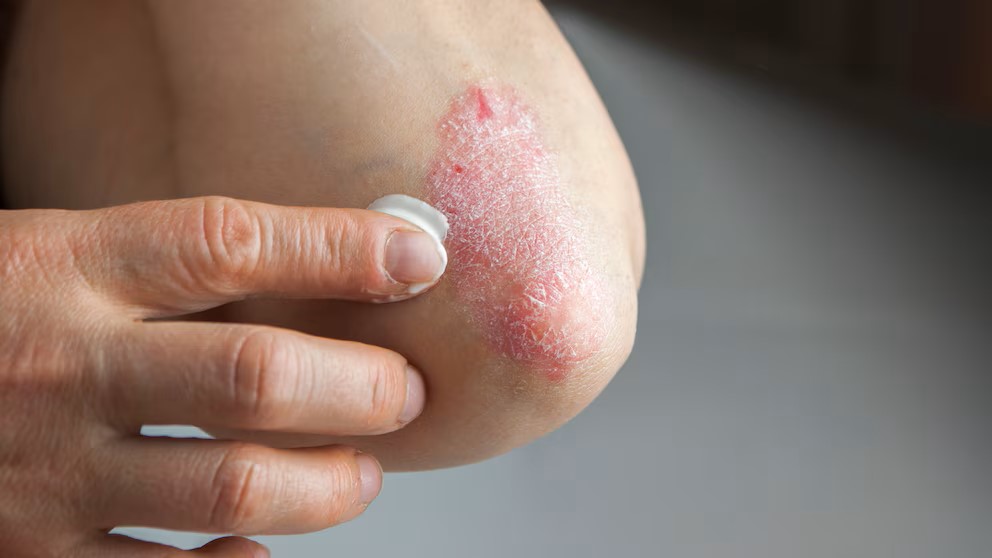 Psoriasis: un mal incurable pero que se sobrelleva con tratamiento y buenos hábitos