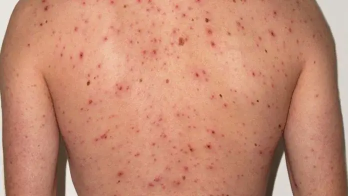 OMS | Los casos de sarampión en América se han multiplicado por 11 en un año