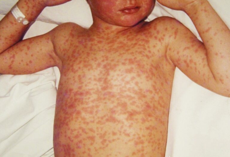 Alerta por sarampión: recomendaciones para residentes en el país que viajen al exterior