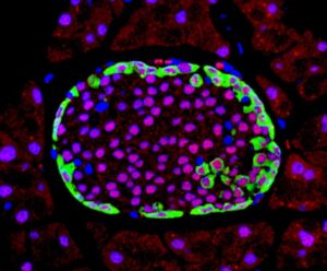 Describen el mecanismo detrás de un gen mutado que predispone a la diabetes tipo 2