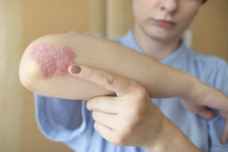 Psoriasis