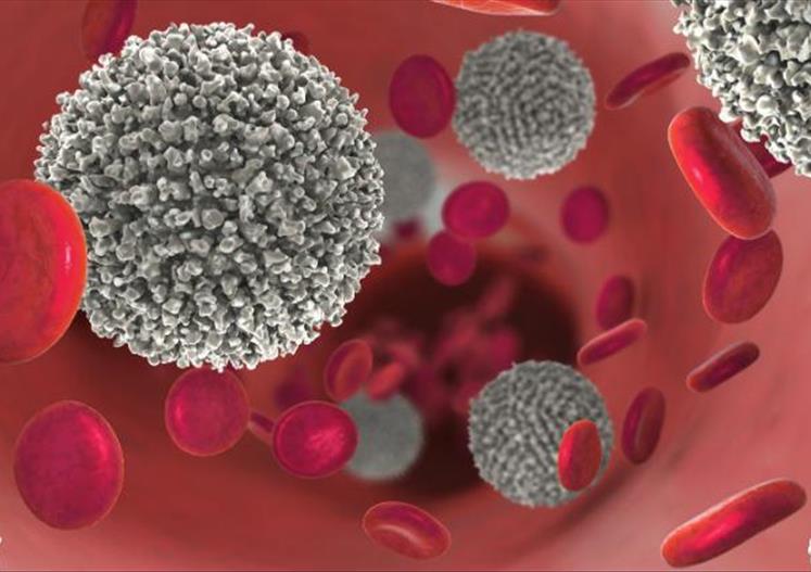 Leucemia Mieloide Aguda: avances científicos mejoran el pronóstico y evidencian desafíos de acceso en Paraguay