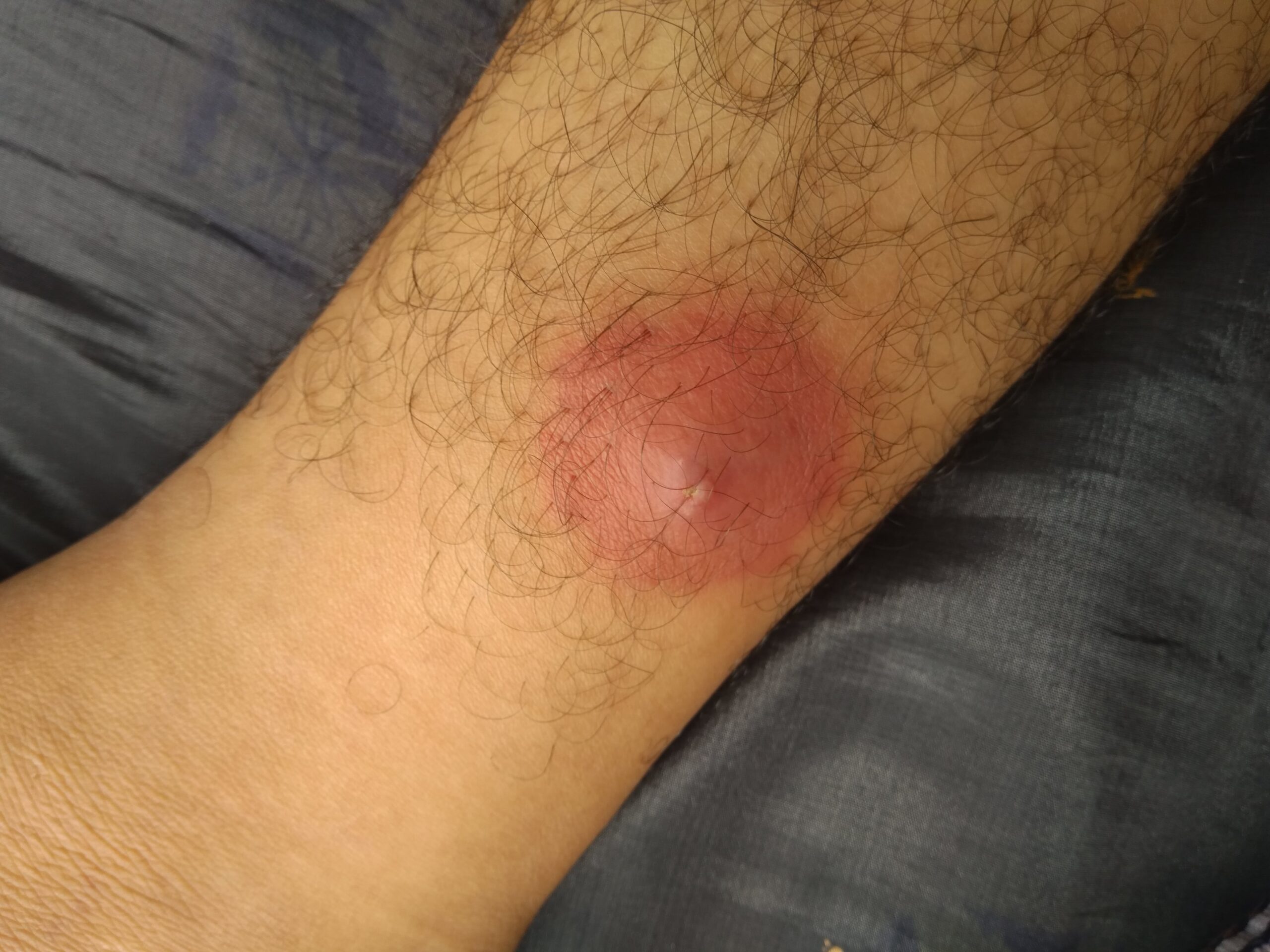 Forúnculos: la pequeña infección que puede volverse un problema serio si se “aprieta” o se ignora