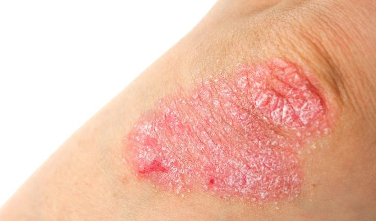 Psoriasis: una enfermedad inflamatoria sistémica que exige abordaje integral