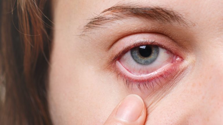 Pantallas y aire acondicionado: la combinación del verano que dispara el ojo seco